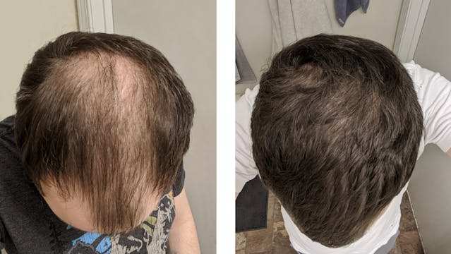 Numankind | David's 5-month hair regrowth story