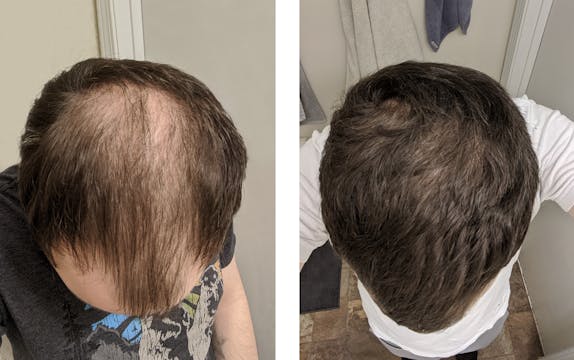 Numankind | David's 5-month hair regrowth story