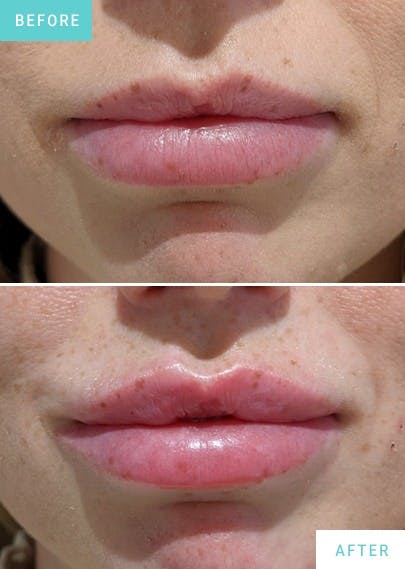 Lip Enhancement - Lip Fillers