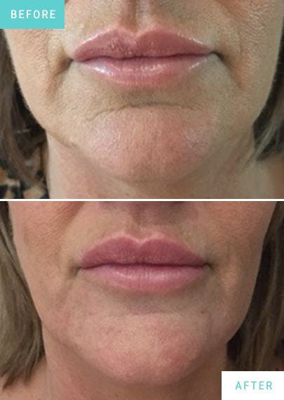 Chin Dermal Filler