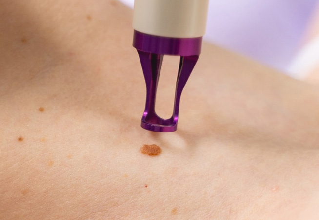 Girl skin tag removal with CryoPen