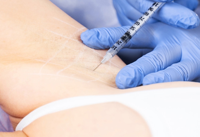 Girl receiving botox for hyperhidrosis injections