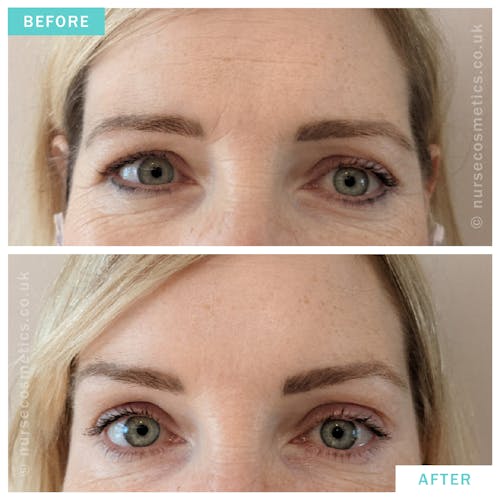 Woman botox brow lift