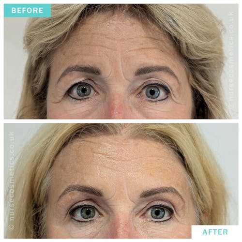 Woman with Botox brow lift 