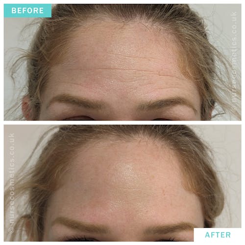 Woman botox for forehead lines