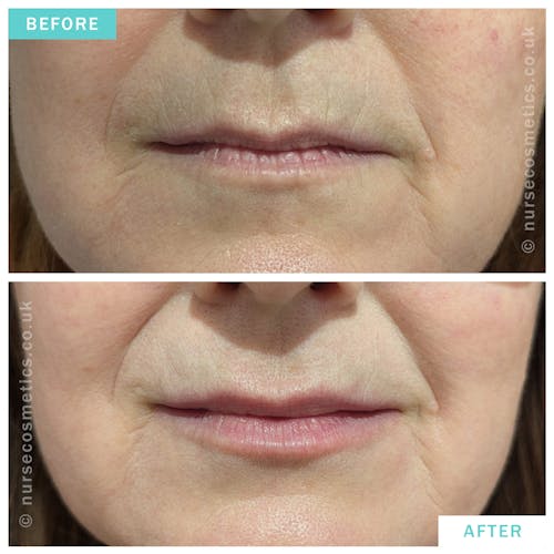 Woman Lip Rejuvenation