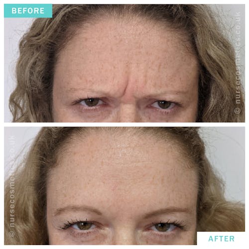 Woman botox for Frown Lines