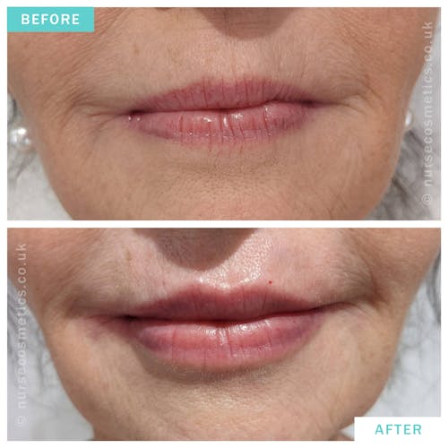 Woman Lip Rejuvenation