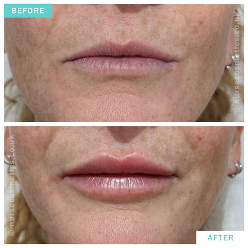 Woman fuller lips with Lip Enhancement