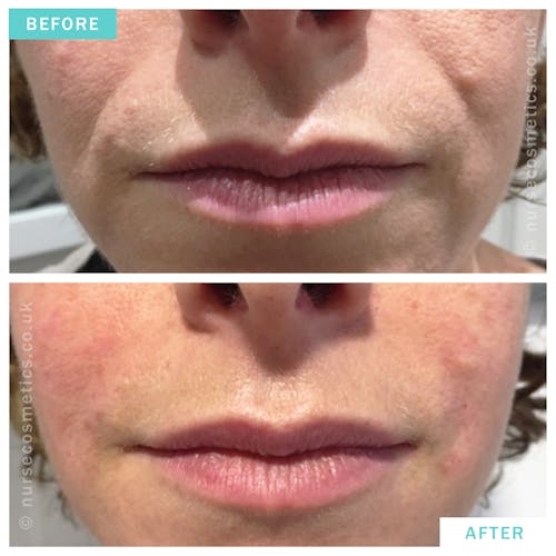 Woman filler for nose to mouth lines