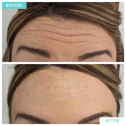 Botox for forehead lines