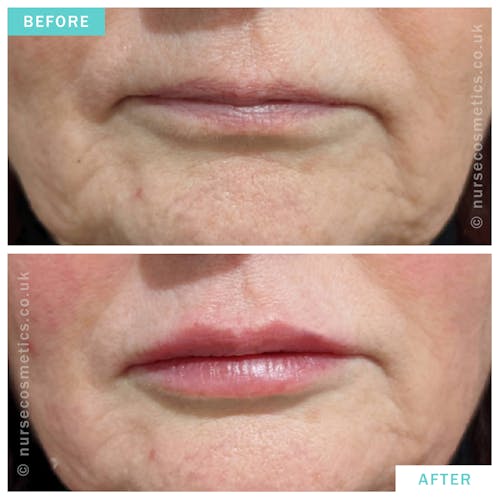 Woman Lip Rejuvenation