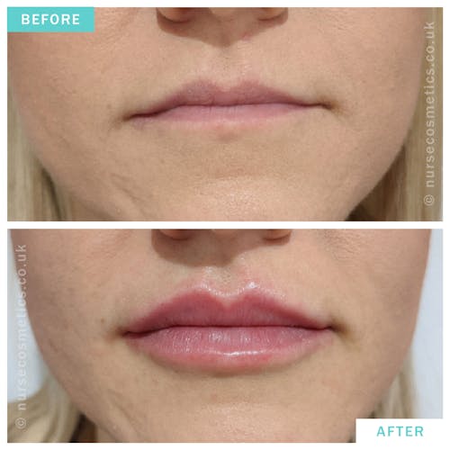 Woman lip enhancement for fuller lips