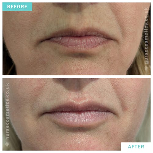 Woman dermal fillers lip rejuvenation 