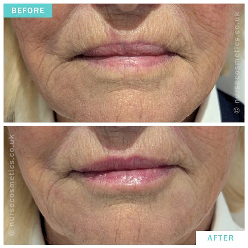 Woman Lip Rejuvenation