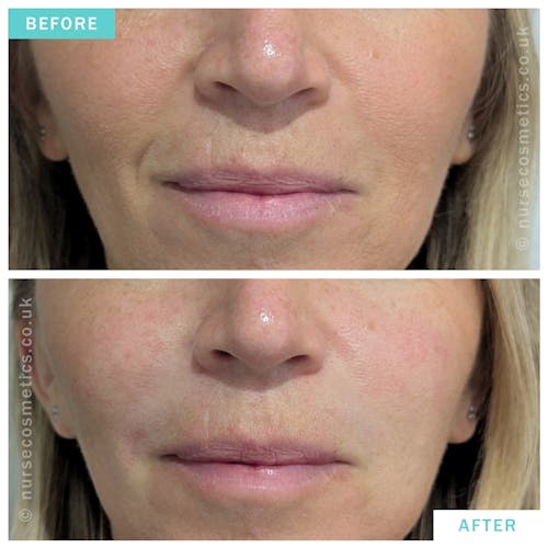 Woman fillers for nose to mouth lines