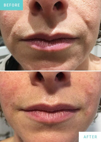 Nose to Mouth Lines Dermal Filler