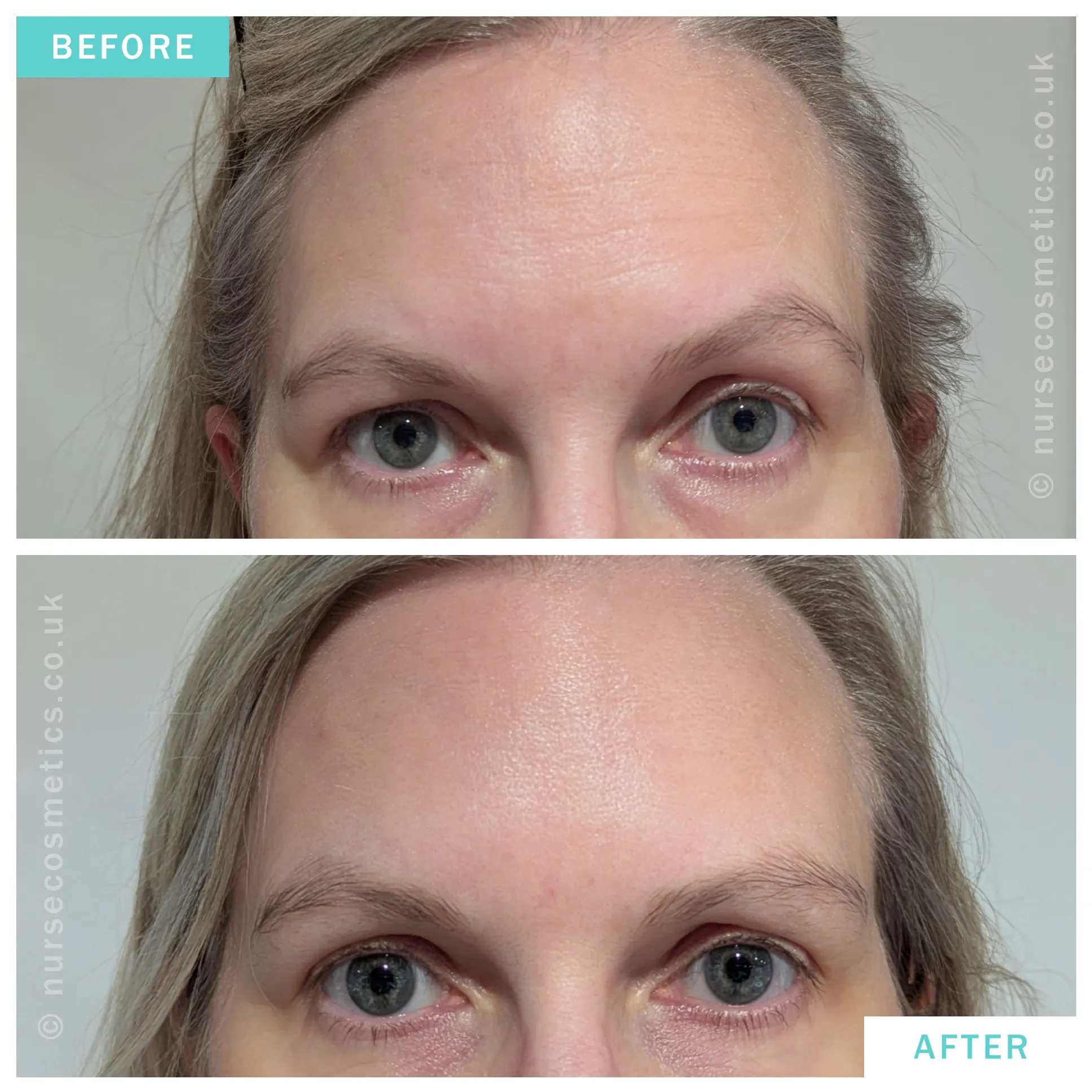 Woman botox for brow asymmetry
