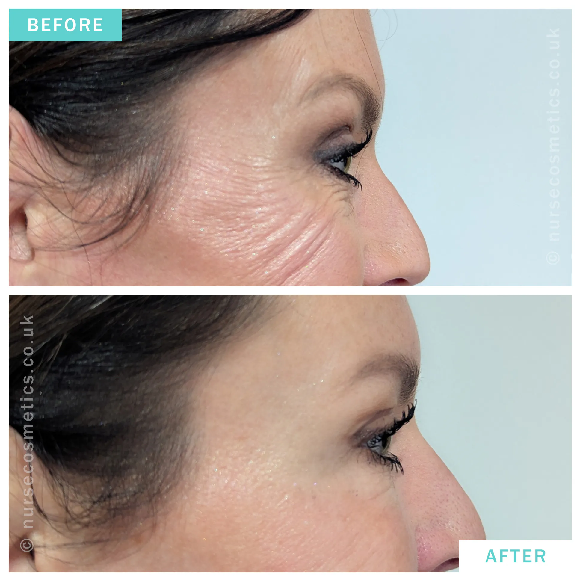 Botox for Crow's feet