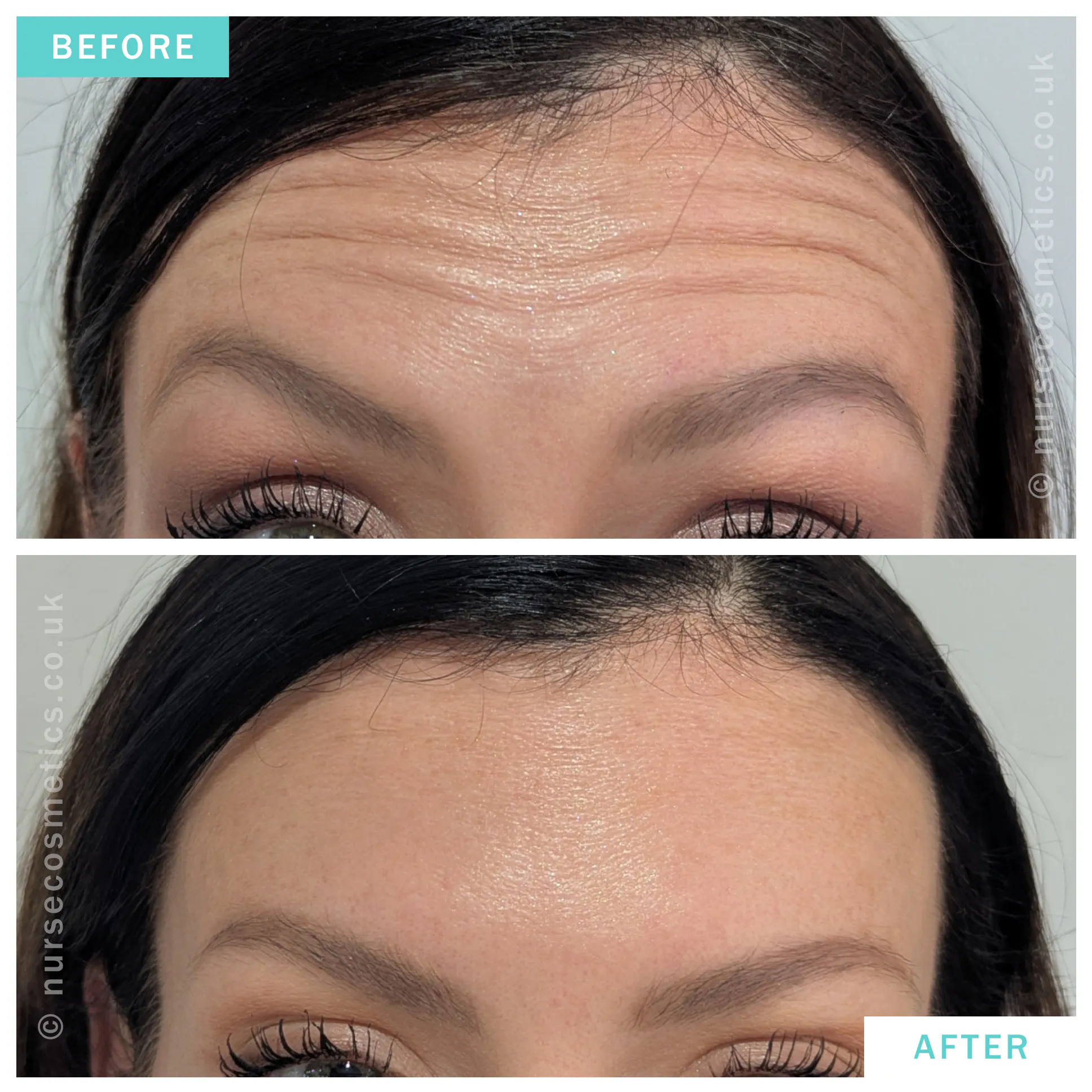 Botox forehead lines