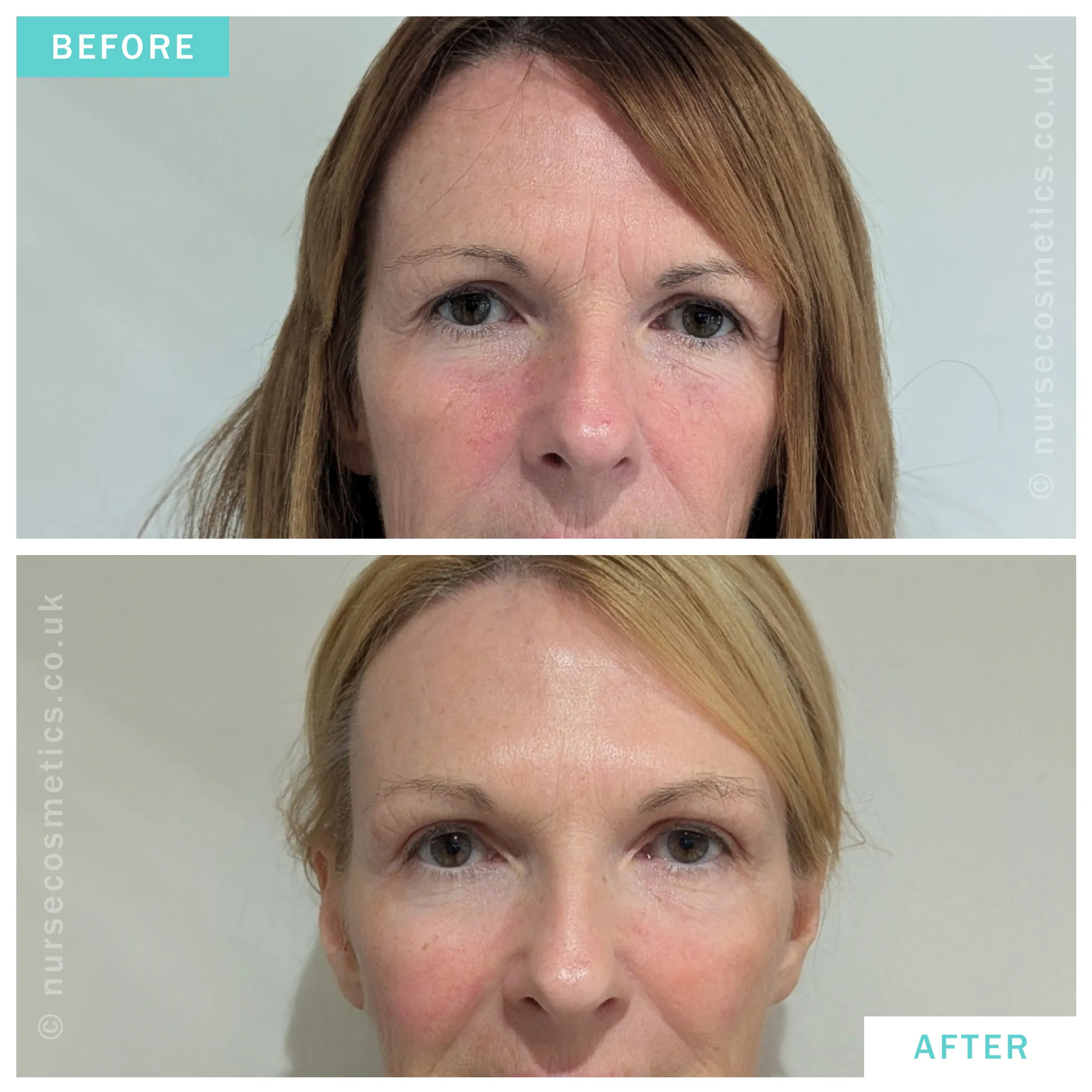 Dermal Filler in Cheeks