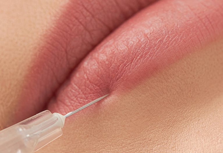 Girl receiving lip augmentation filler injections