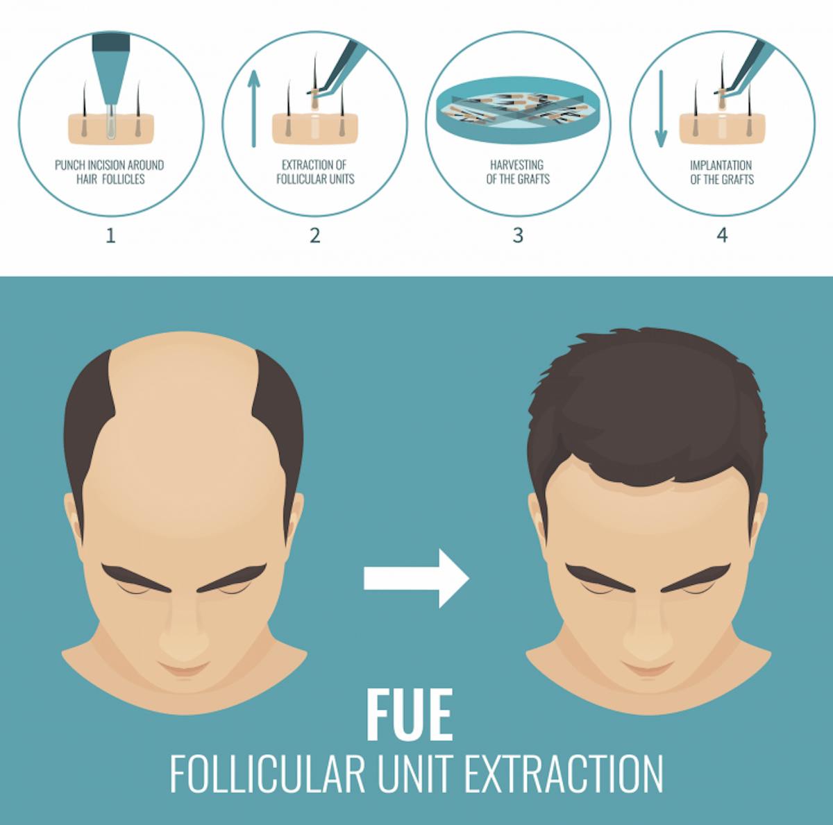 Fue Hair Transplant What You Need To Know Nutrafol