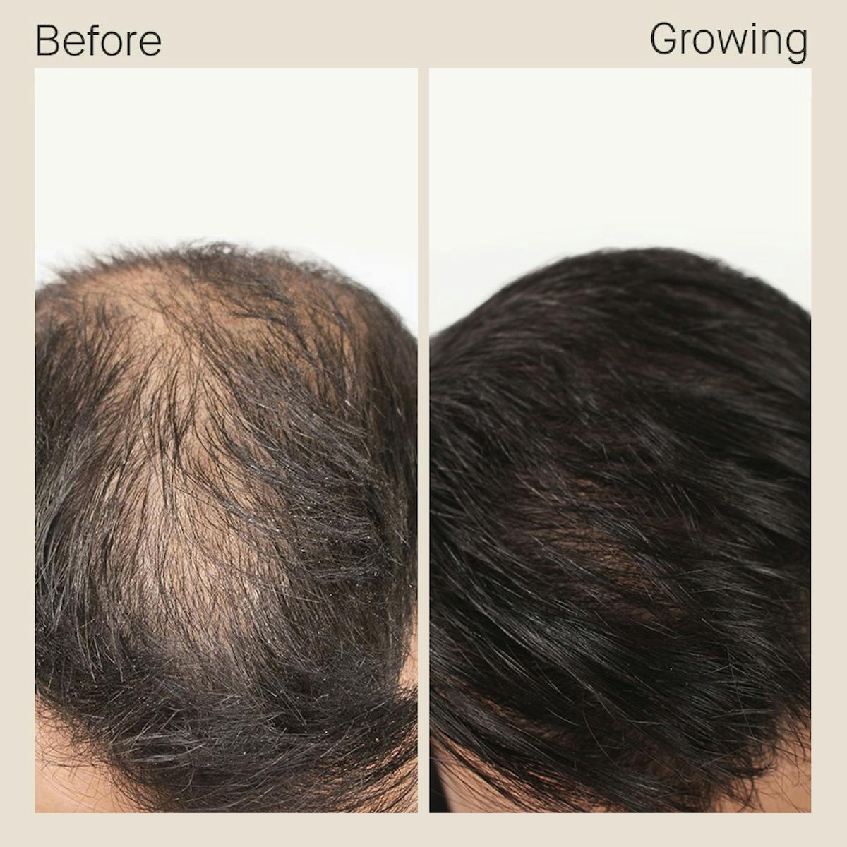 These Men Transformed Their Hair With Nutrafol Nutrafol