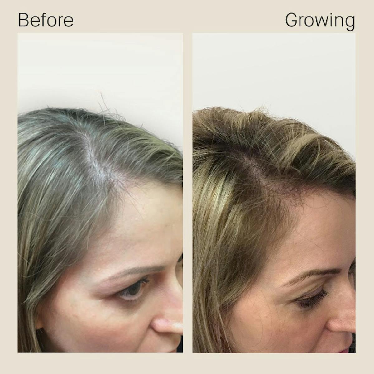 12 People Who Transformed Their Hair With Nutrafol | Nutrafol