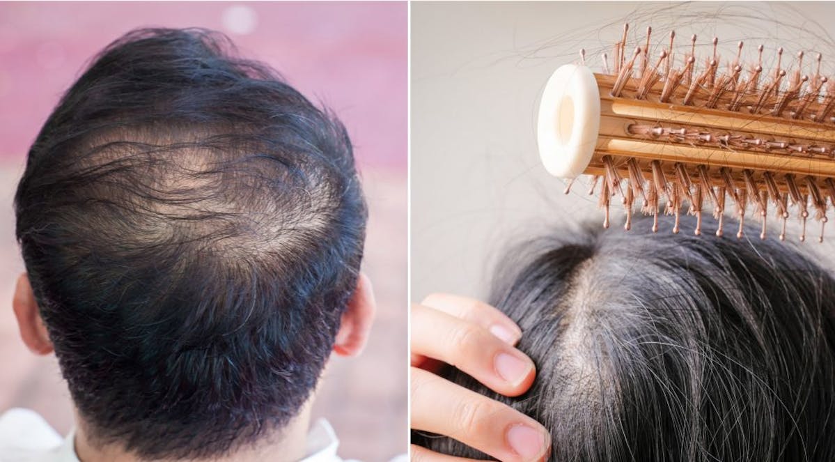 The 4 Different Types of Hair Loss | Nutrafol