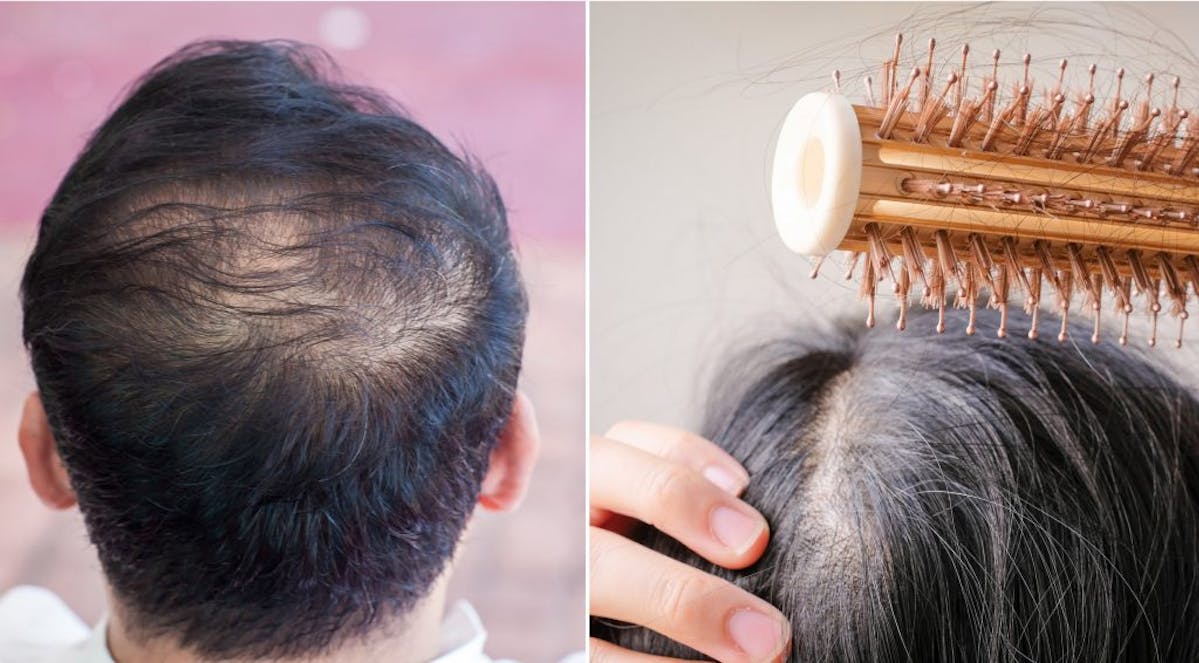 The 4 Different Types Of Hair Loss Nutrafol The 4 Different Types Of Hair Loss Nutrafol