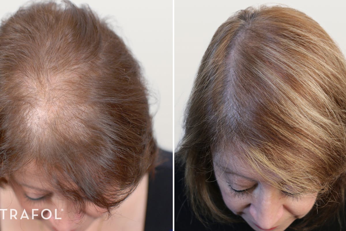 12 People Who Transformed Their Hair With Nutrafol | Nutrafol