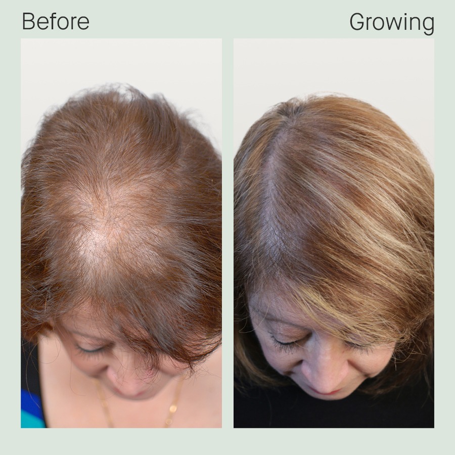 12 People Who Transformed Their Hair With Nutrafol Nutrafol