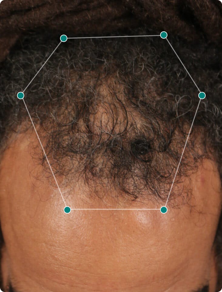 null before taking Nutrafol Men Hair Growth Nutraceutical.