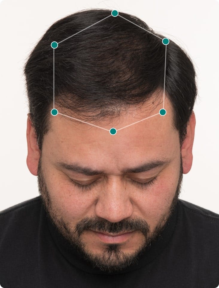 Jose’s scalp 6 months growing with Nutrafol. Results may vary.