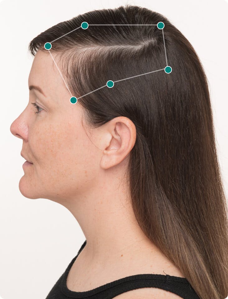 Lindsey before taking Nutrafol Women Hair Growth Nutraceutical.