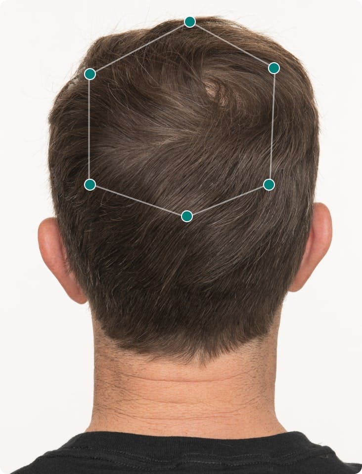 Mark 3 months into taking Nutrafol Men Hair Growth Nutraceutical. Results may vary.