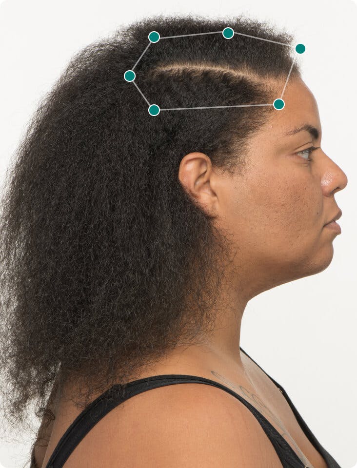 Dawnte 3 months into taking Nutrafol Women Hair Growth Nutraceutical. Results may vary.