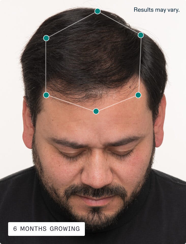 Jose’s scalp 6 months growing with Nutrafol.