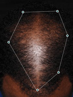 User before taking Nutrafol Men Hair Growth Nutraceutical.