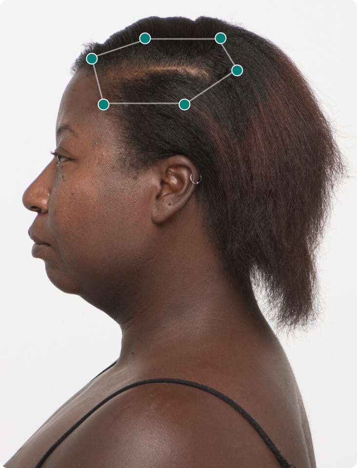 Terry before taking Nutrafol Women Hair Growth Nutraceutical.
