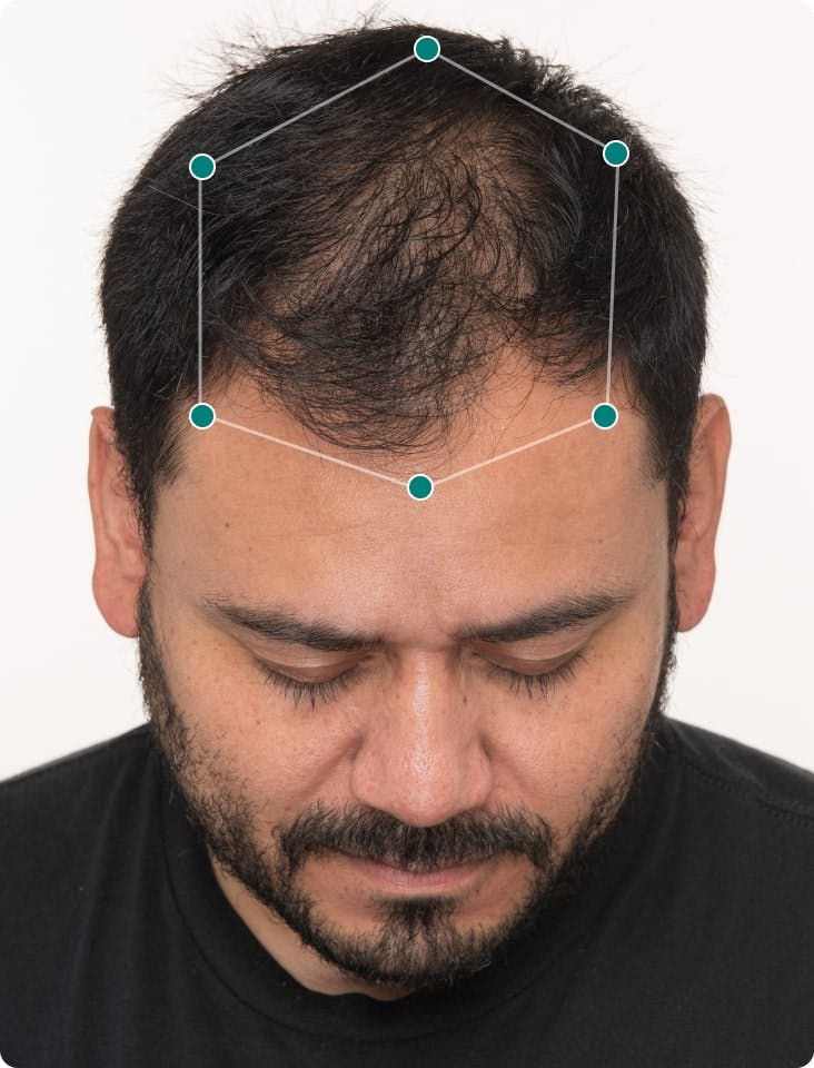 Jose's scalp before taking Nutrafol.