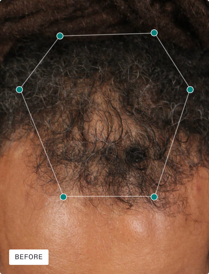 Kyron’s scalp before taking Nutrafol.