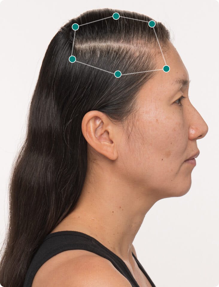 Karin before taking Women’s Balance Hair Growth Nutraceutical.