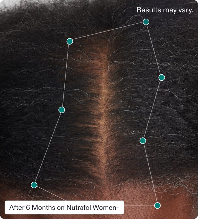 User 6 months after taking Nutrafol Women Hair Growth Nutraceutical. Results may vary.