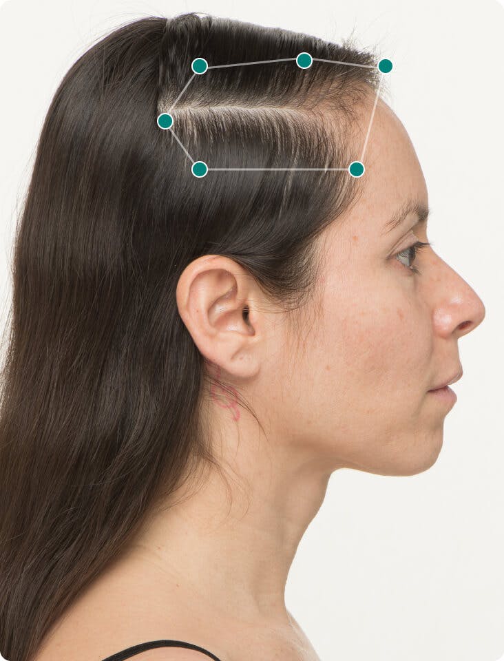 Alejandra 6 months into taking Nutrafol Women Hair Growth Nutraceutical. Results may vary.
