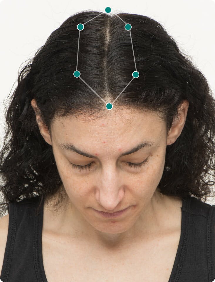Aliza 6 months into taking Nutrafol Women Hair Growth Nutraceutical. Results may vary.