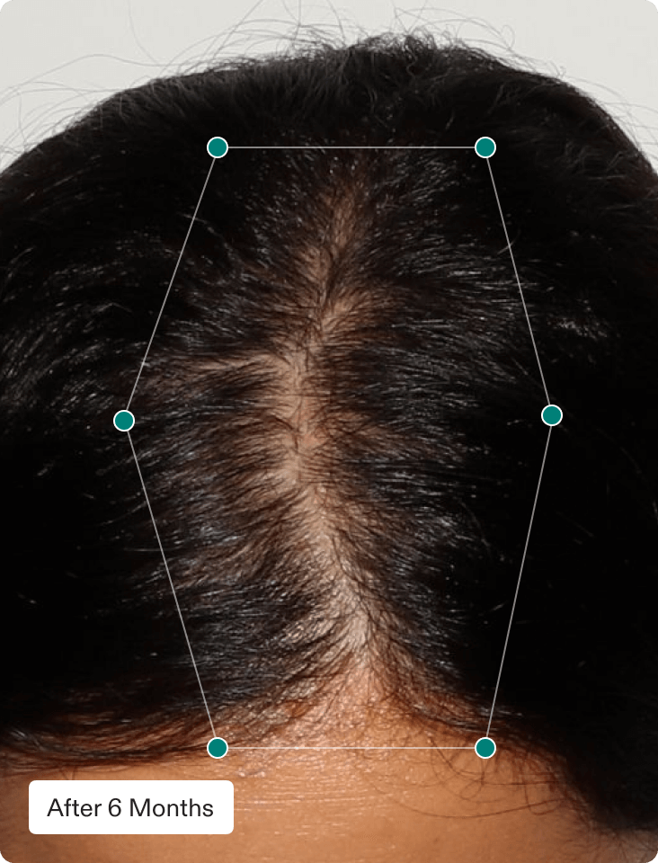 Hormone Support Hair Growth Duo | Nutrafol Hormone Support Hair Growth Duo | Nutrafol