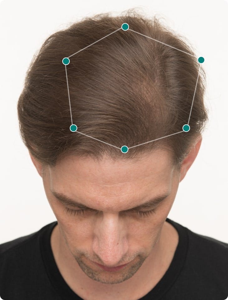 Sam 3 months into taking Nutrafol Men Hair Growth Nutraceutical. Results may vary.