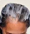 Woman's scalp with Root Purifier Shampoo applied throughout the hair and scalp.